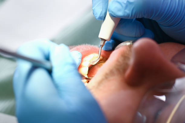Best Emergency Dental Extractions in Oronoque, CT
