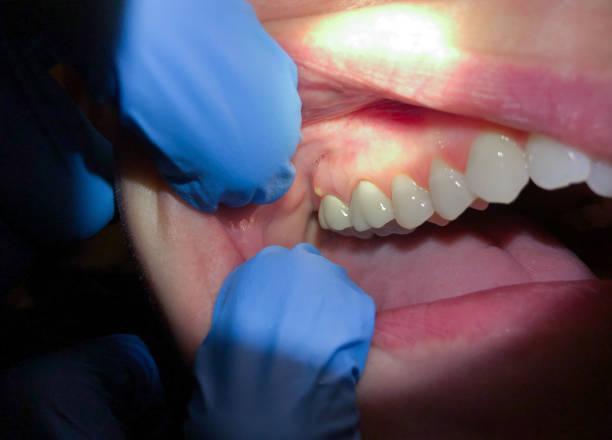 Best Emergency Dental Care for Abscessed Tooth in Oronoque, CT