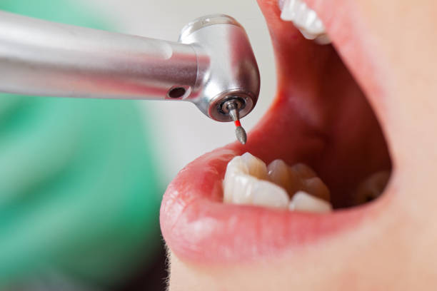 Best Emergency Dentist for Knocked-Out Tooth in Oronoque, CT